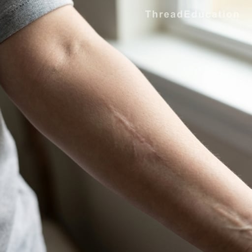 Vivre avec des fragments de balle dans le corps : les risques méconnus